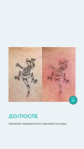 Удаление татуировок и перманентного макияжа / татуажа неодимовым лазером Capello до и после 1